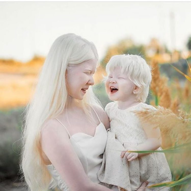 Albinismo uguale bellezza 